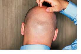 الرجل الاصلع مفهوم اخر للجاذبية لدى عالم الفتيات