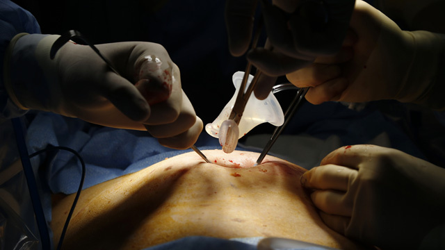 اشتعال النار بمعدة بريطاني أثناء عملية جراحية