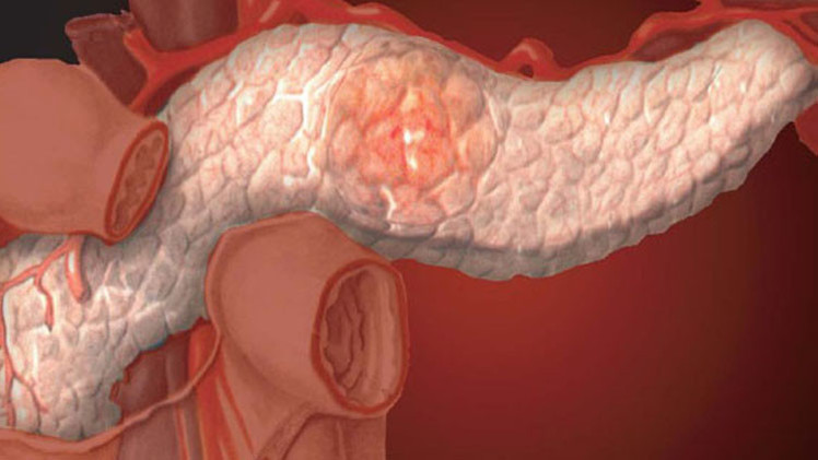 أسلوب الحياة الصحي في مراحل مبكرة يحمي من الإصابة بسرطان البنكرياس