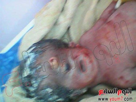بالصور.. ولادة طفل بعين واحدة وأنف مسمار في مصر