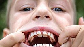 طفل بريطاني في الثامنة يحصل على لقب ‘الفك المفترس’