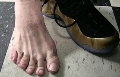 صورة.. نجم عالمي يكشف عن امتلاكه 6 أصابع في القدم