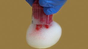 طريقة فريدة لوقف نزيف الجروح بنسبة 90%