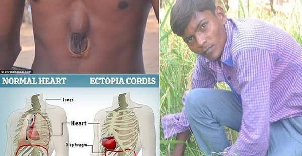 فيديو: حالة نادرة لشاب هندي قلبه ينبض خارج جسمه منذ 18 عاماً