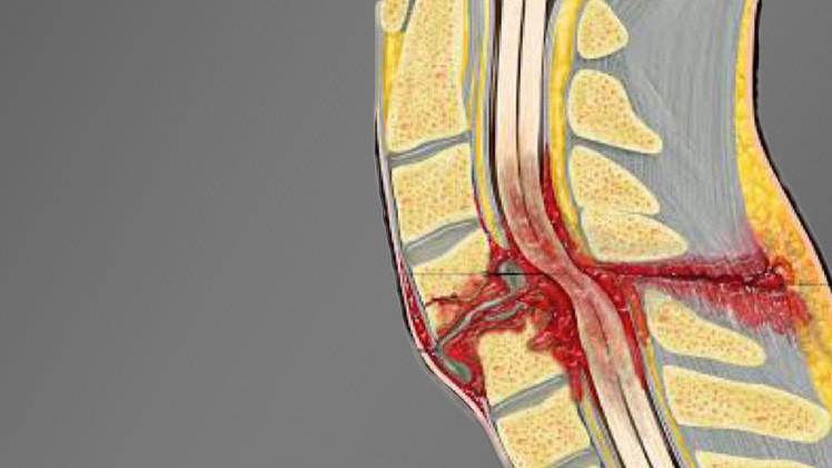 العلماء يتوصلون الى طريقة لعلاج اصابات النخاع الشوكي