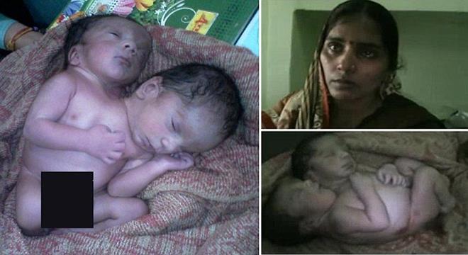ولادة طفل برأسين والأب يعتقد أنه “عقاب الآلهة” !!