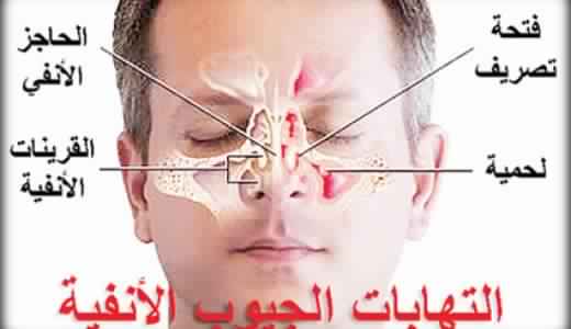 أنواع التهابات الجيوب الأنفية وطرق علاجها