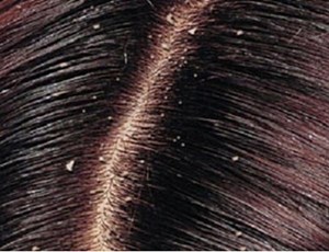 علماء يقتربون من حل مشكلة قشرة الرأس