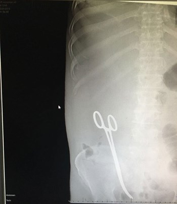 بعد أن نسي الطبيب مقصا ببطنه.. المريض: يده كانت ترتعش