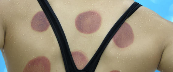 لماذا يستخدم أبطال ريو 2016 الحجامة؟