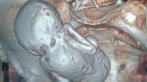 جزائرية تصدم الاطباء:عمرها تجاوز السبعين و في بطنها جنينا عمره 35 سنة!