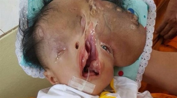 طفل يولد بلا جمجمة وبنصف وجه في تايلند وهذا مصيره!