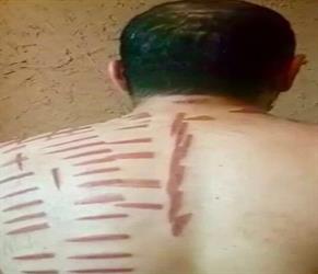 بالفيديو.. هذا ما فعله معالج شعبي بشاب سعودي باستخدامه “الكي” دون ترخيص