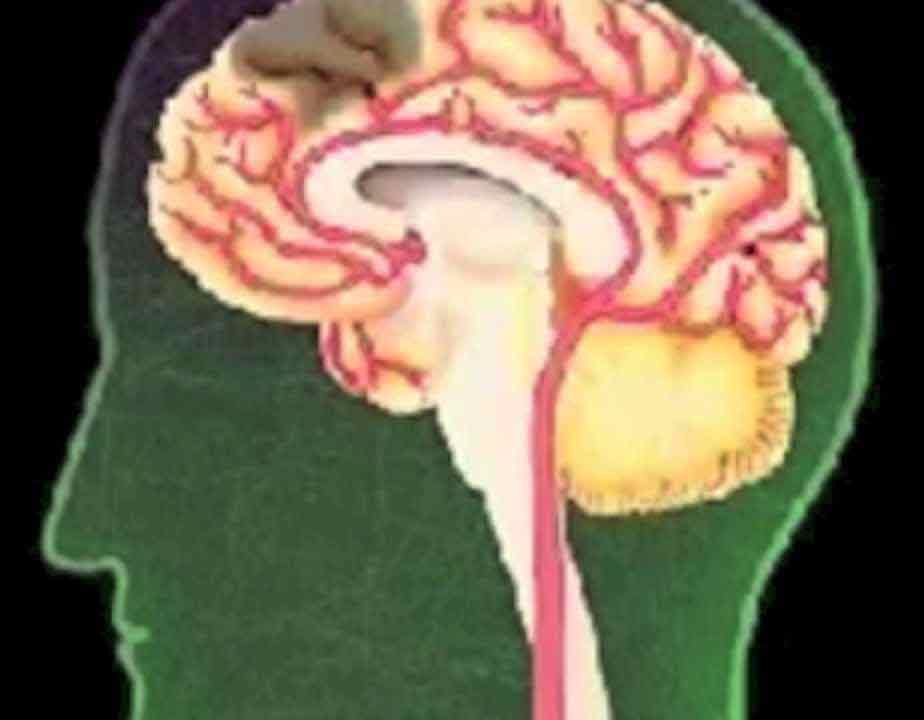 بالفيديو.. كيف تحدث السكتة الدماغية؟
