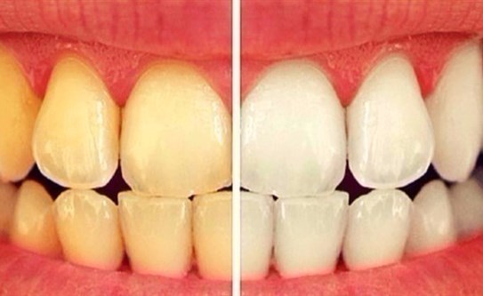 10 أطعمة ومشروبات تؤدي إلى اصفرار أسنانك