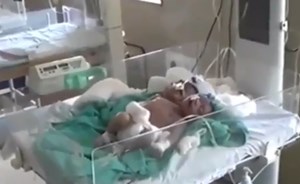 بالفيديو.. امرأة تنجب طفلاً برأسين وثلاثة أذرع