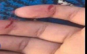 بالفيديو..معلمة تمزق يد طالبة ضربا بمسطرة خشبية في المدينة