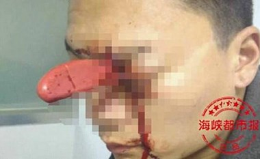 ماذا حدث بعد أن طعنته زوجته بسكين في عينه؟