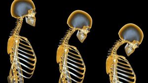 Osteoporosis