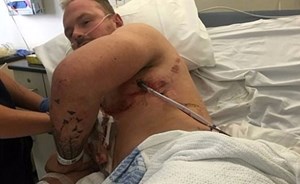 عامل ينجو بأعجوبة بعدسقوطه من ارتفاع لتخترق ثلاثة قضبان معدنية صدره