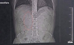 استخراج قلمين من معدة رجل بعد 36 عاماً من ابتلاعهما