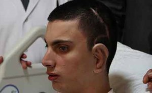 لأول مرة.. زراعة أذن من غضروف إنسان حي