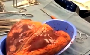 بالفيديو.. قلب حقيقي بقي ينبض خارج الجسم لـ25 دقيقة لهذا السبب!!