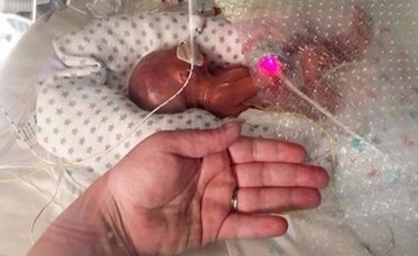 طفل معجزة ولد وزنه نصف كيلو يخالف توقعات الأطباء