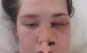 شابة تخسر عينها بسبب خراج في ضرسها