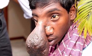 إزالة ورم بحجم كرة تنس من وجه فتى هندي