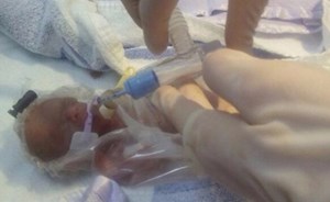 طفلة معجزة بحجم كرة تنس تتحدى توقعات الأطباء