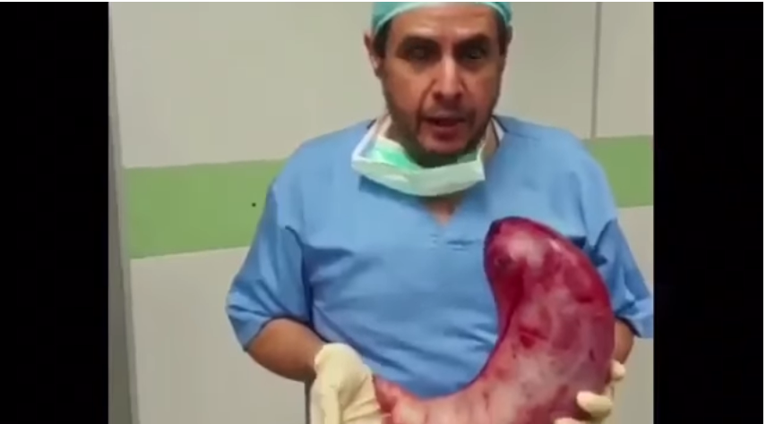 بالفيديو – طبيب يحمل معدة بشرية ضخمة ويحذر من «كارثة»