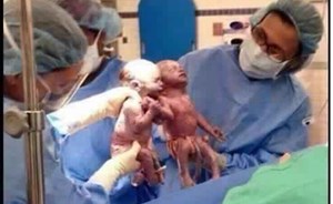 وفاة أغرب توأم في العالم بعد 24 ساعة من ولادته