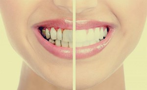 غسيل الأسنان في هذا التوقيت يصيبها بالتسوس: خطأ يومي تقع فيه