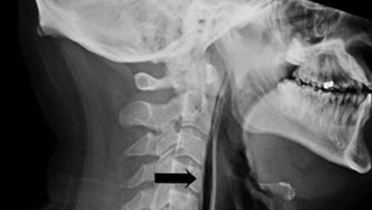 تحذير طبي: رجل كَتَم عطسته.. فكُسرت رقبته!
