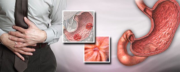 علاجات طبيعية لقرحة المعدة.. أبرزها العسل واللبن