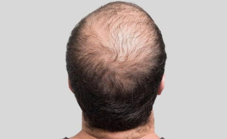 اكتشاف علاج جديد يعزز نمو الشعر ويقضي على الصلع