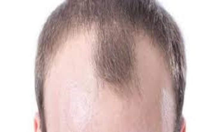 5 أطعمة تحميك من الصلع