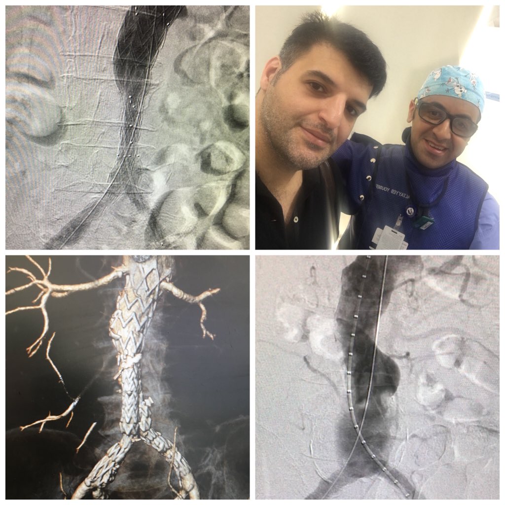 طبيبان كويتيان ينجحان في علاج حالة لإنفجار الشريان الاورطي لمريض عمره 85 عام