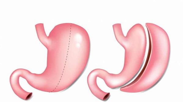 استئناف عمليات السمنة بضوابط.. قريباً