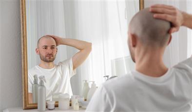 دراسة تكشف عن علاج طبيعي للصلع عند الرجال