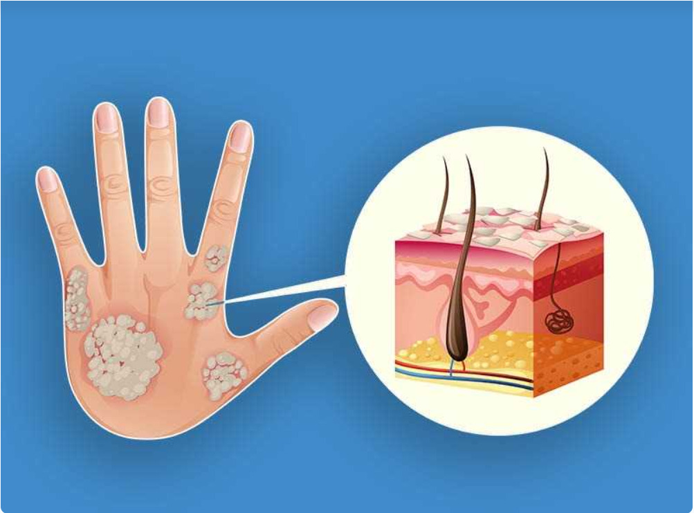 الغليسيرين.. علاج واعد للصدفية