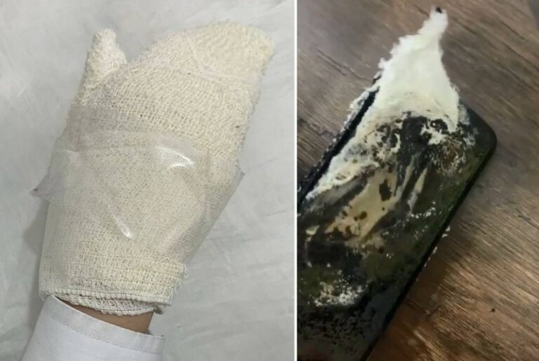 شاهد إصابة فتاة بحروق في يدها بسبب اشتعال جوالها الموصول بالشاحن