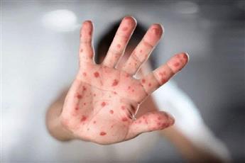 بسبب جدري القردة.. الصحة العالمية تمدد حالة الطوارئ الصحية عالميا