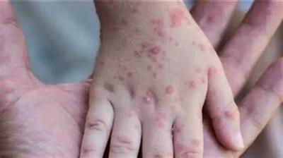الصحة العالمية: يمكن القضاء على جدري القرود في 6 أشهر
