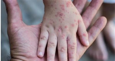 الأردن: تسجيل إصابة بجدري القرود لمقيم غير أردني